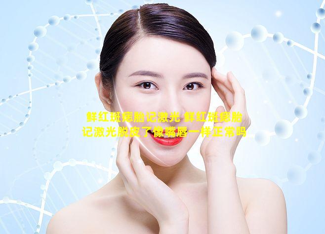 鲜红斑痣胎记激光 鲜红斑痣胎记激光脱皮了像嘴唇一样正常吗